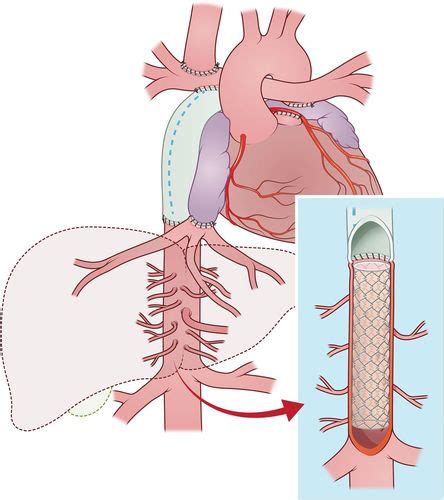 Original Surgical Procedure For The Treatment Of Protein Losing