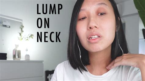 Lump On Neck Lymphoma Cancer Youtube