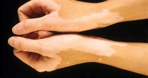 How To Treat Hyperpigmentation Spots On Arms And Legs