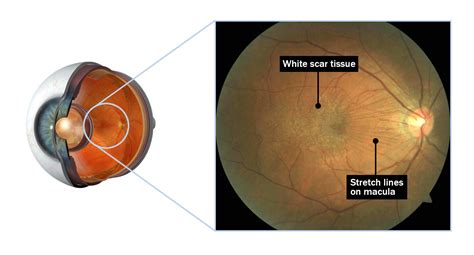 Epiretinal Membranes Eye Doctors Mona Vale