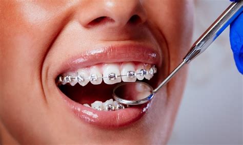 Teeth Whitening With Braces What You Need To Know