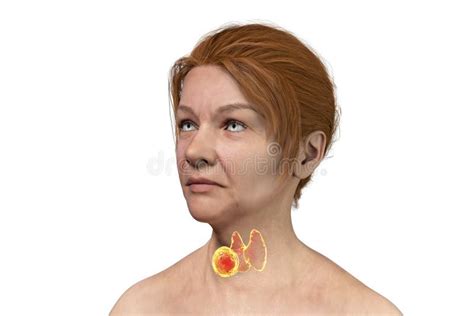 Thyroid Cancer In Women Stock Illustration Illustration Of Illness