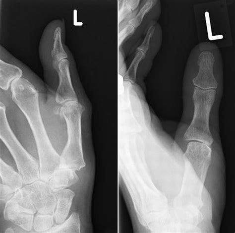 Osteoarthritis At The Base Of The Thumb The Bmj