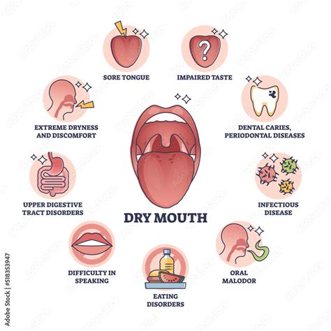 Vecteur Stock Dry Mouth Or Xerostomia As Salivary Glands Saliva Problem