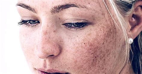 Hyperpigmentation Causes Types And Treatment Premier Clinic