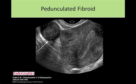 Pedunculated Fibroid Ultrasound Sonography Medical Mnemonics Gyno