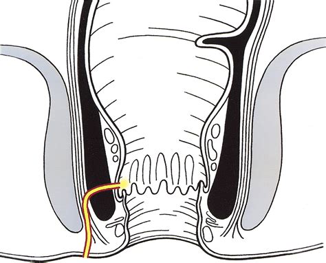 Mr Imaging Classification Of Perianal Fistulas And Its Implications For