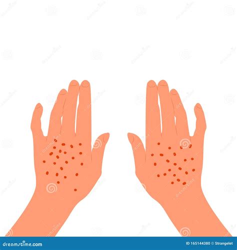 Red Rash On The Back Of The Female Hands Skin Illness Allergy