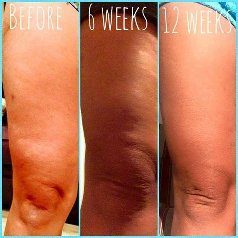 Great Before And Afters Nerium Firm Fitmomma Nerium Com Nerium Firm