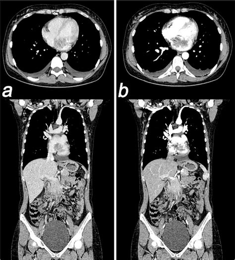 A And B Thoracoabdominal Pelvic Ct Scan Showed A Tumoral Mass In The