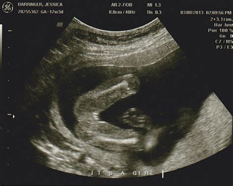 Pics Photos Its A Girl 17 Week Gender Ultrasound