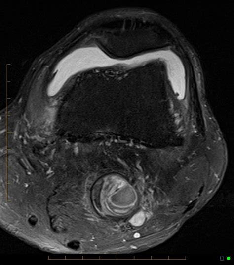 Incidental Popliteal Artery Aneurysm On Mri Knee Radiology Case
