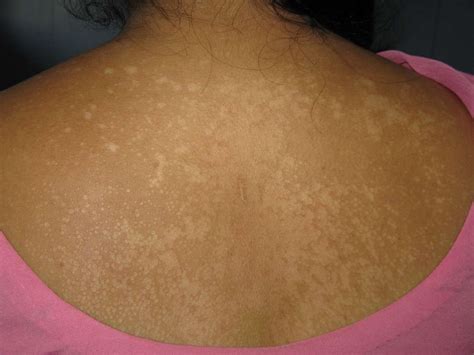 Pityriasis Versicolor Dermacosm