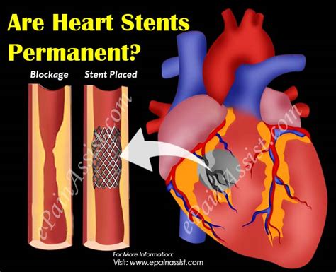 Are Heart Stents Permanent