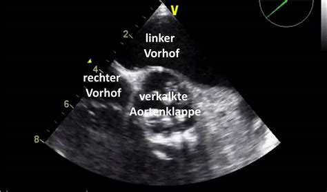 Aortenklappenstenose In Der Mid Oesophageal Aortic Valve Short Axis