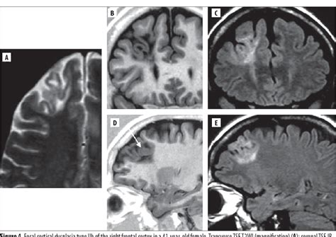 Figure 4 From Focal Cortical Dysplasia Review Semantic Scholar