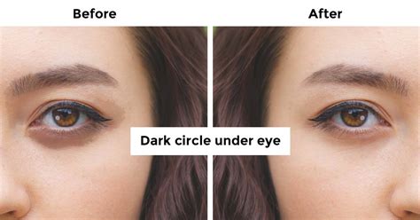 How To Remove Dark Circle Under The Eye Advanced Holistic Ways