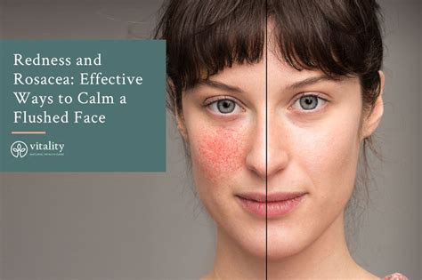 Redness And Rosacea Effective Ways To Calm A Flushed Face