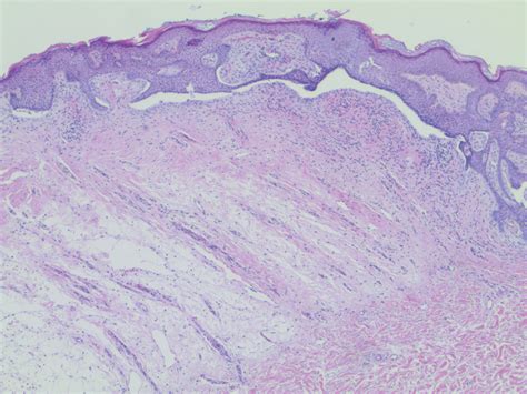 Pigmented Basal Cell Carcinoma With Annular Leukoderma Mdedge Dermatology