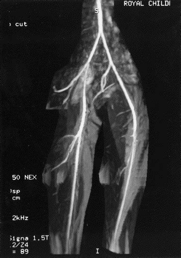 Mra Versus Angiogram For The Diagnosis Of Peripheral Arterial Disease