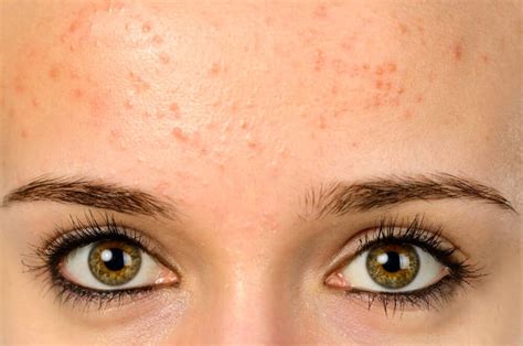 How To Get Rid Of Fungal Acne In 2022 According To Dermatologists
