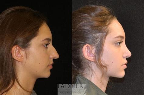 Rhinoplasty Nose Job Before And After Photo Gallery Denver Co