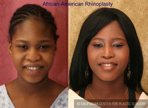 Patient Rhinoplasty African American Before And After Photos Encino Plastic Surgery