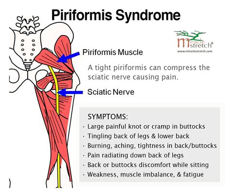 Best 25 Piriformis Syndrome Symptoms Ideas On Pinterest Piriformis