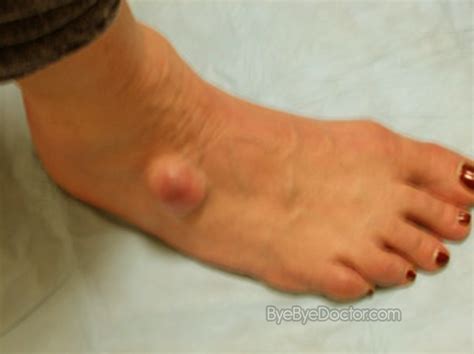 Narrow feet pain is much better but still lump and some bruise. Ganglion Cyst Foot - Pictures, Surgery, Treatment, Removal