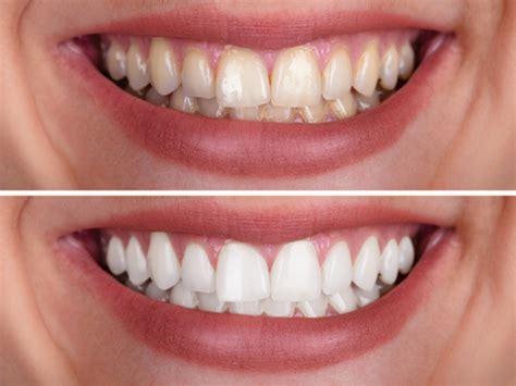Teeth Whitening Cost Brisbane Cosmetic Dentist Fortitude Valley