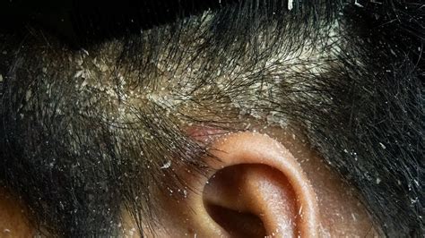 Scratching Dandruff On Left Side Of Head Dandruff Removal Big Flakes