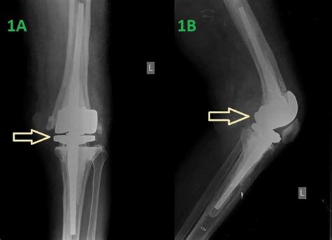 Cureus Spontaneous Knee Hemarthrosis Due To Hypofibrinogenemia