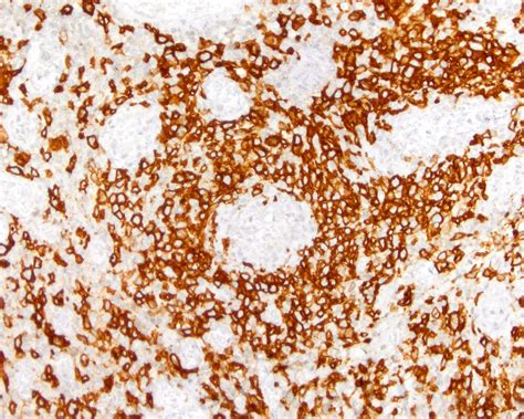 Pathology Outlines Enteropathy Associated T Cell Lymphoma