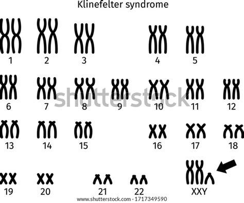 Scheme Klinefelter Syndrome Karyotype Human Somatic เวกเตอรสตอก