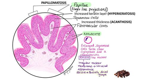 SQUAMOUS PAPILLOMA Pathology Made Simple