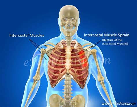 Rib Cage Muscles And Tendons Intercostal Muscle Strai