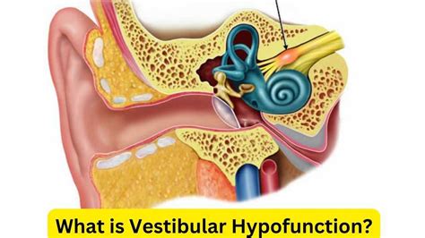 What Is Vestibular Hypofunction Causes Symptoms Treatment