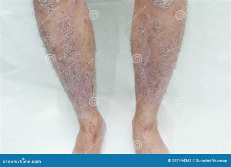 Skin Disease From Psoriasis Stock Photo Image Of Limb Shoe 247444362