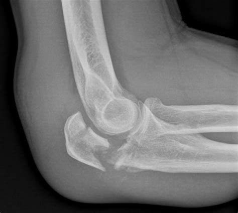 Olecranon Fracture Raleigh Hand Surgery — Joseph J Schreiber Md