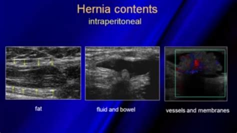 Ultrasound Of Hernias Membrane Sonography Ultrasound