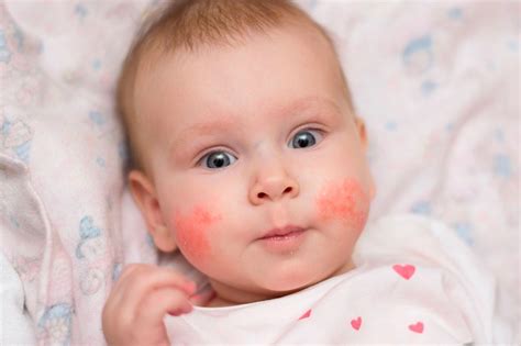 Dermatite Atópica Na Infância Dra Mariana Godoi Em Itajubá