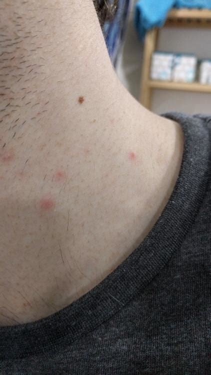 Any Help Identifying These Small Acne Spots On My Neck Backbody