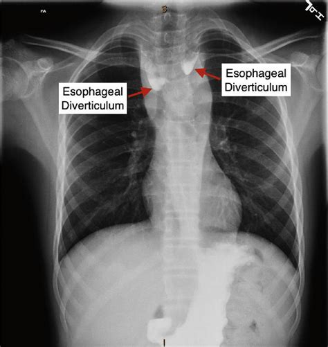 Large Bilateral Esophageal Diverticula And Esophageal Narrowing At The