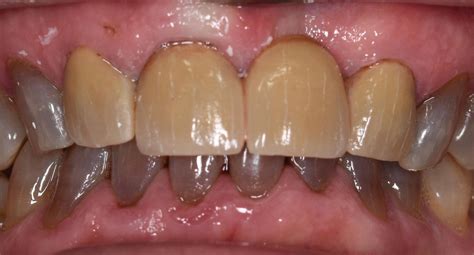 Worn Cracked Or Broken Teeth Bega Dental Practice