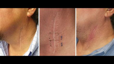 Deep Fx Co2 Laser Treatment Of Neck Scar By Dr Joe Niamtu Iii Youtube