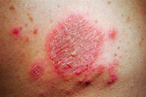 Discoid Eczema Nidirect