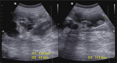 Mature Cystic Teratoma Dermoid In A 22 Year Old Woman In Whom