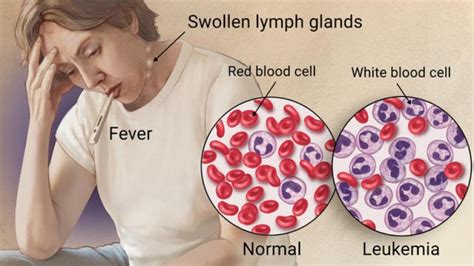 High White Blood Cell Count