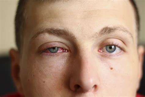Causes Of Swelling Eyelids Hobart In Deen Gross Eye Centers