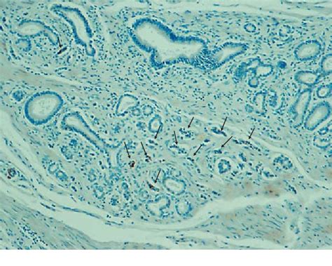 Figure 1 From Histopathology Of The Minor Duodenal Papilla Semantic